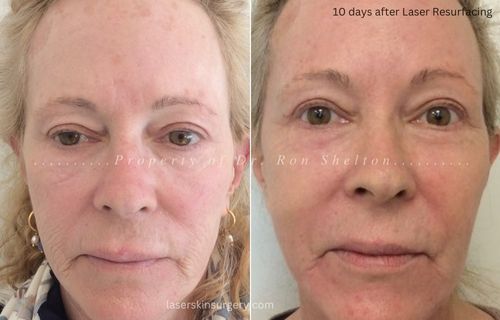 10 days after Halo/Profractional for skin graft/scar resurfacing right temple and Profractional laser resurfacing And Sciton Laser MicroPeel on seborrheic keratosis and lentigines (brown spots, liver spots).
