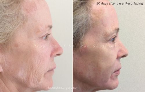 10 days after Halo/Profractional for skin graft/scar resurfacing right temple and Profractional laser resurfacing And Sciton Laser MicroPeel on seborrheic keratosis and lentigines (brown spots, liver spots).