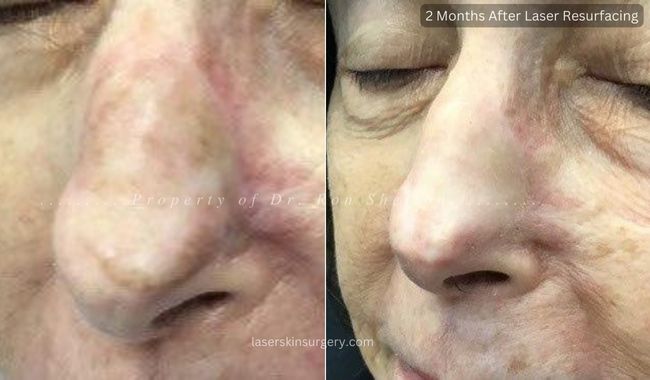 Before and 2 Months after Erbium Ablative Laser Resurfacing