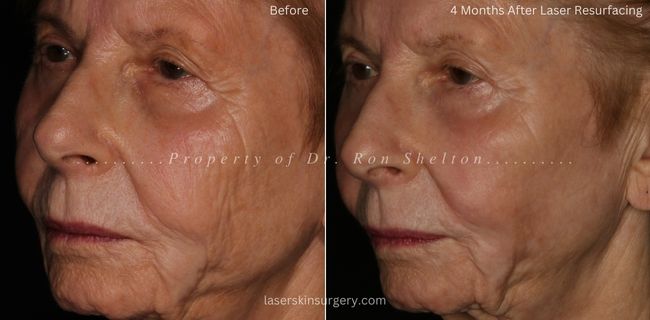 Before and 4 Months after Laser Resurfacing, Sciton Contour and Profractional