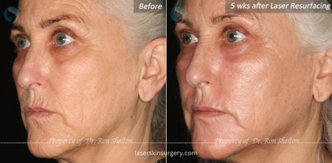 Before and 5 Weeks After Sciton Erbium ablative Laser Resurfacing for Sun Damage and Wrinkles