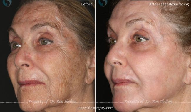 Before and After Sciton Erbium ablative Laser Resurfacing for Sun Damage and Wrinkles