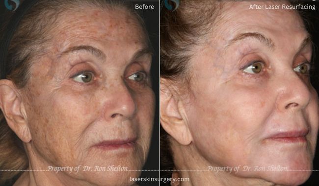 Before and After Sciton Erbium ablative Laser Resurfacing for Sun Damage and Wrinkles