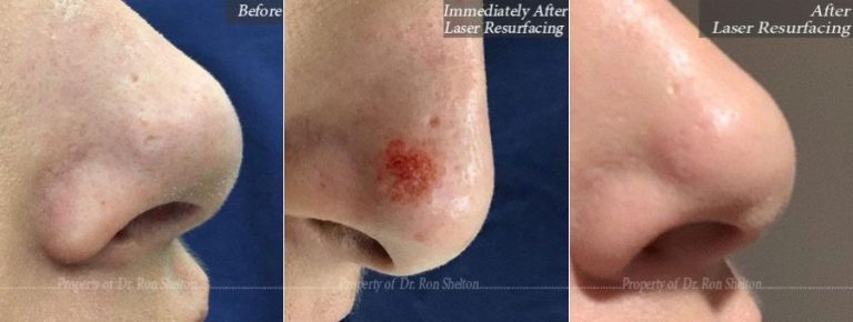 Before and Immediately after Laser Resurfacing
