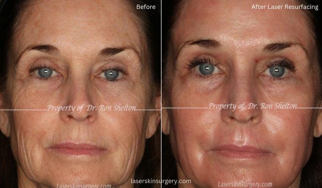 Above patient’s images show only 3 weeks post fully ablative erbium laser (Sciton Contour), full face. Laser resurfacing for sun damage, wrinkles etc.