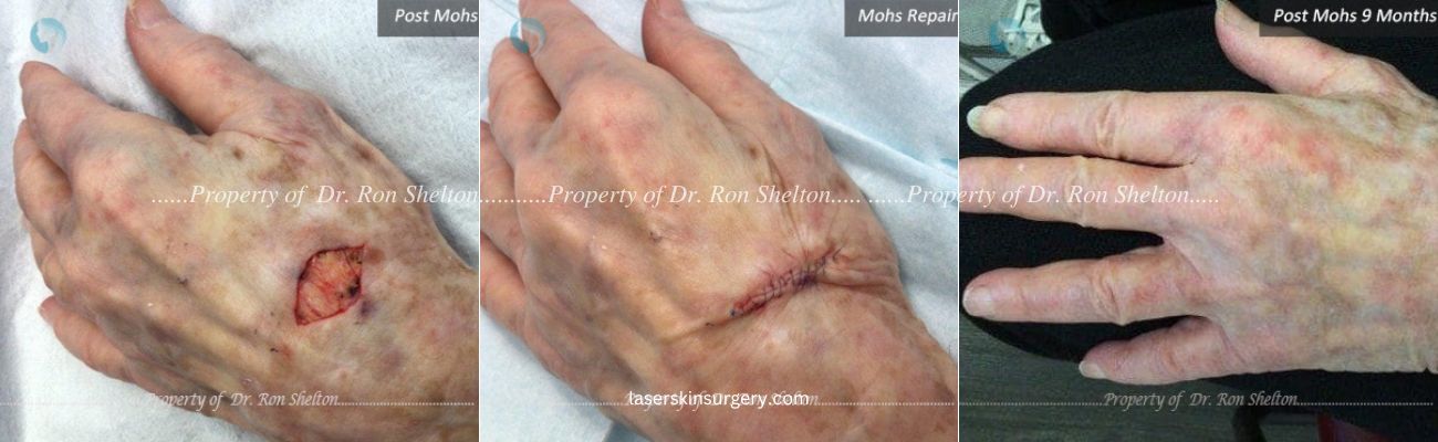 Imperceptible Scar Hand 9 Months after Mohs Surgery