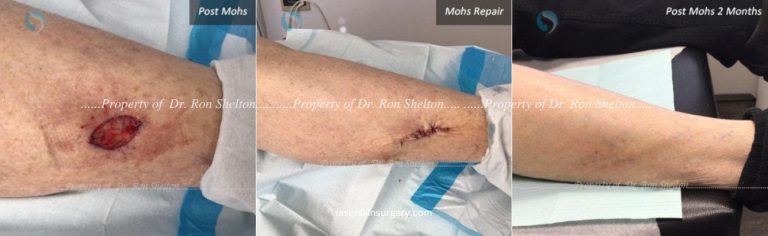 Post Mohs on lower leg, Mohs Repair and After 2 Months