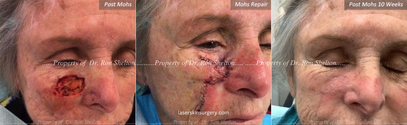 Mohs Surgery on the Cheek, Repair and After 10 Weeks