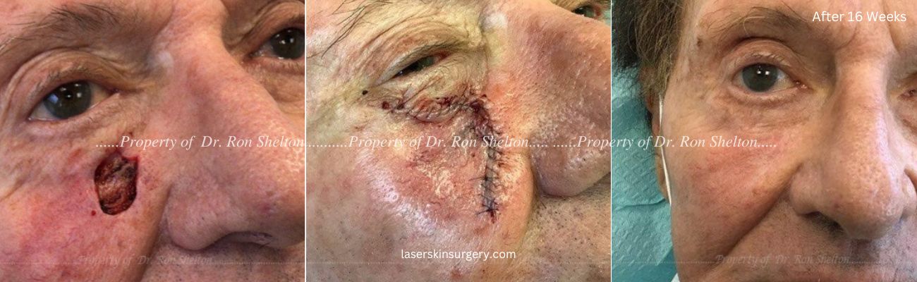 Mohs Surgery on the Cheek, Repair and After 16 Weeks