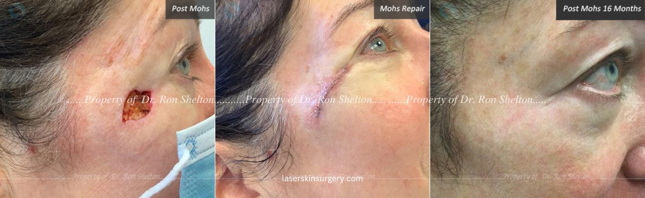 Mohs Surgery on the Cheek, Repair and After 16 Months