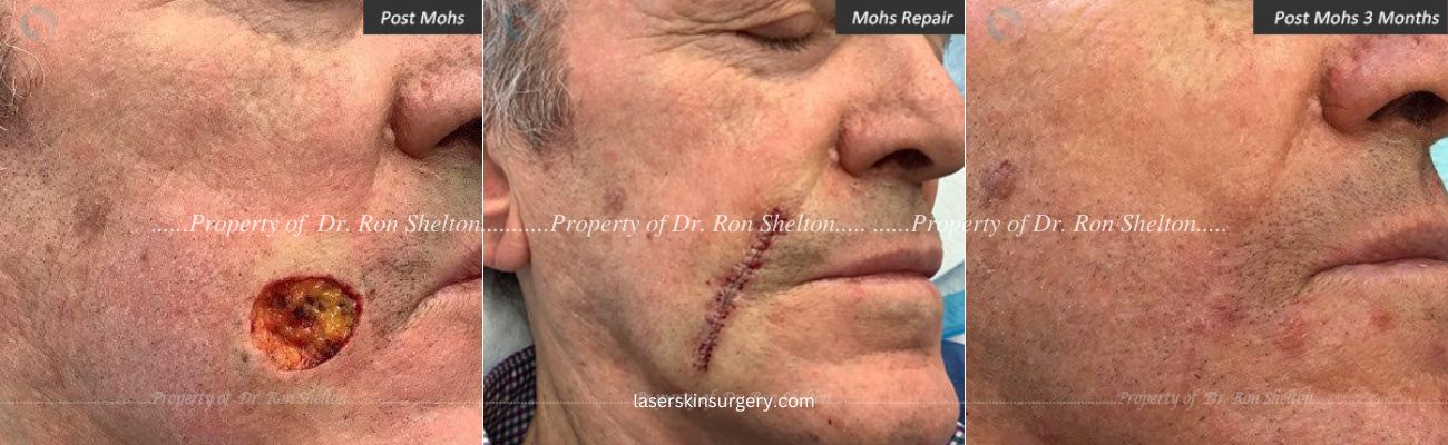 Mohs Surgery on the Cheek, Repair and After 3 Months