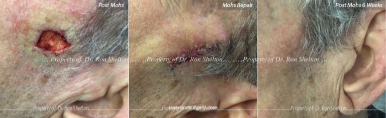 Mohs Surgery on the Cheek, Repair and After 6 Weeks