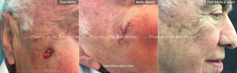 Mohs Surgery on the Cheek, Repair and After 6 Years