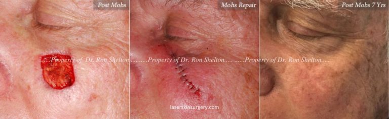 Mohs Surgery on the Cheek, Repair and After 7 Years