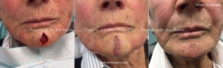 Mohs Surgery on the Chin, Mohs Repair and After 16 Weeks