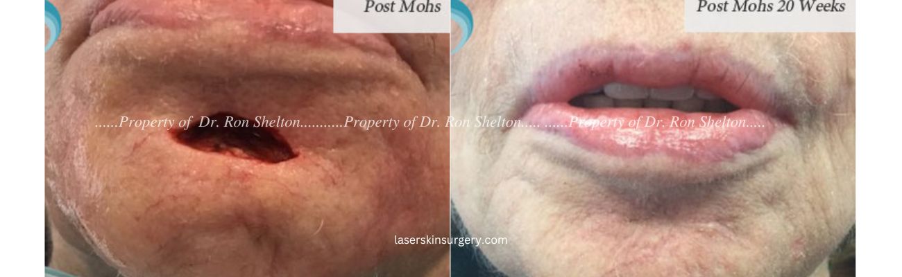 Mohs Surgery on the Chin and After 20 Weeks