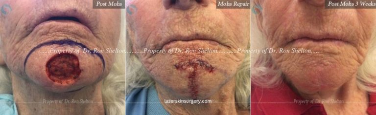 Mohs Surgery on the Chin, Mohs Repair and After 3 Weeks