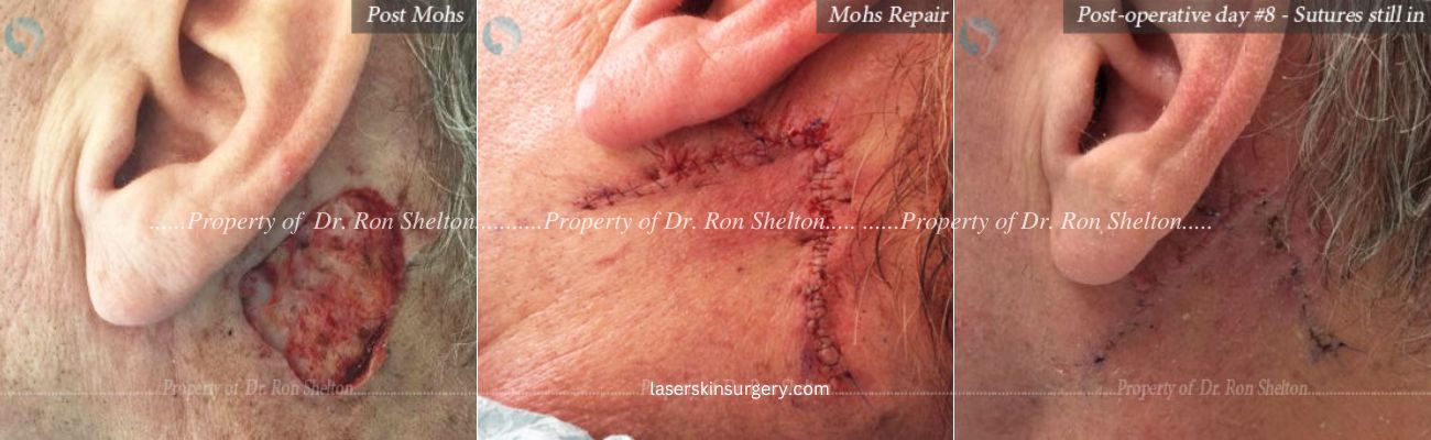 Post Most Surgery on the Ear, Mohs Repair and Post operative day #8 – Sutures still in