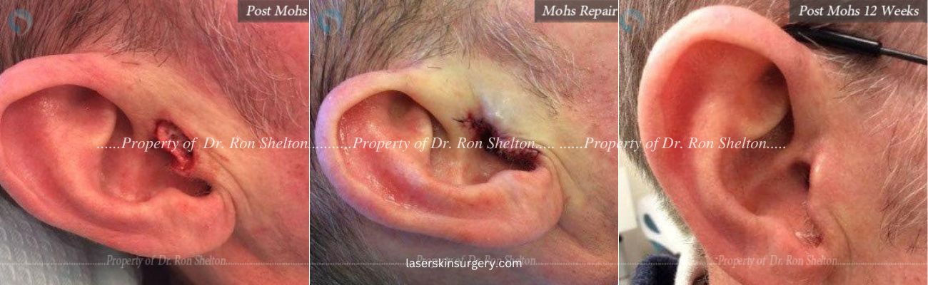 Post Mohs Surgery on the Ear, Mohs Repair and After 12 Weeks