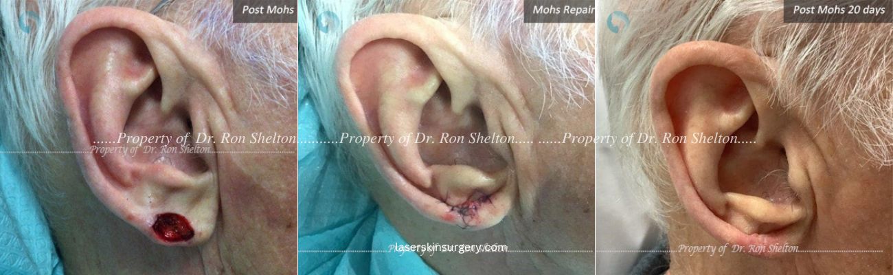 Post Mohs Surgery on the Ear, Mohs Repair and After 20 Days