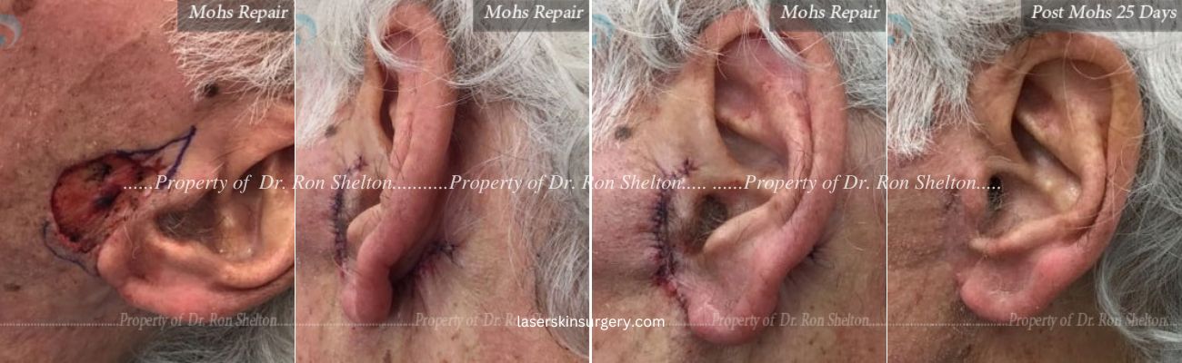Post Mohs Surgery on the Ear, Stitches placed behind the ear as well similar to a facelift, Mohs Repair and After 25 Days