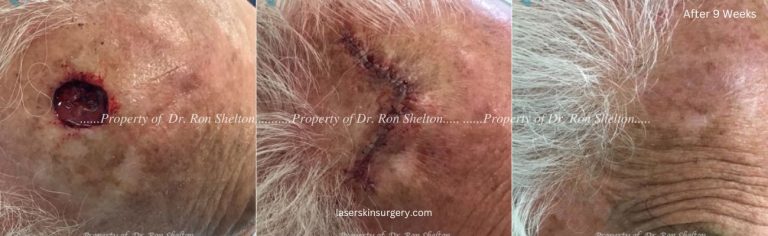 Mohs Surgery on the Forehead, Repair and After 9 Weeks