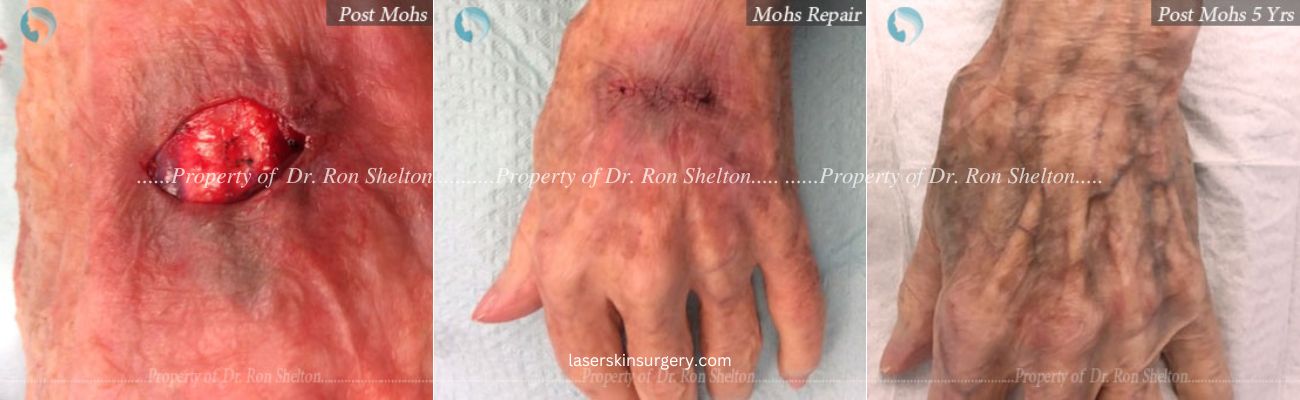 Post Mohs Surgery on the Hand, Mohs Repair and After 5 Years
