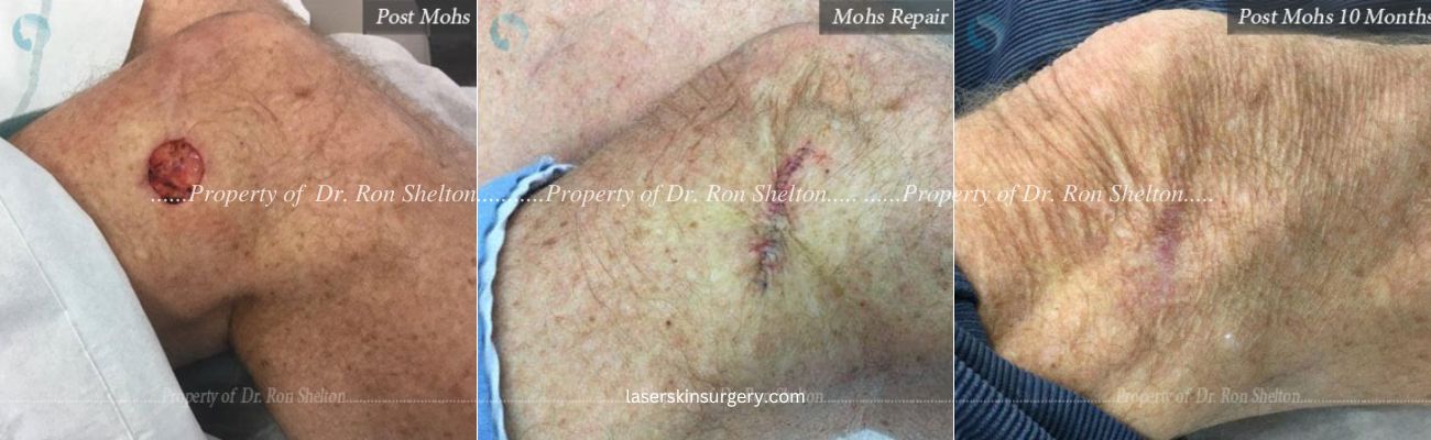 Mohs Surgery on the Knee, Mohs Repair and After 10 Months