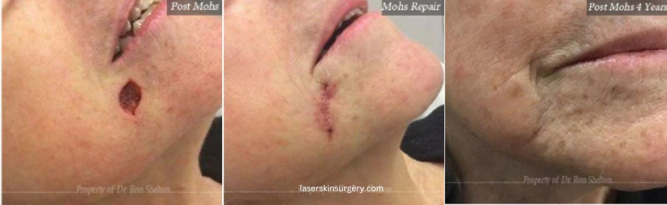 Mohs Surgery on the Lip and After 4 Years
