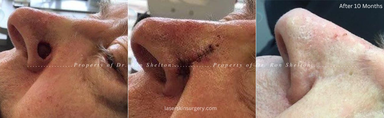 Mohs surgery on the nurse, post repair and after 10 months