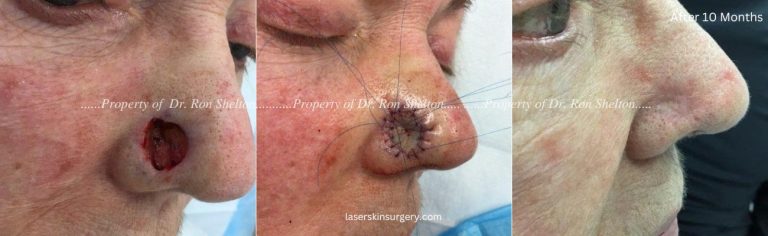 Mohs surgery on the nose, Mohs Repair and After 10 Months