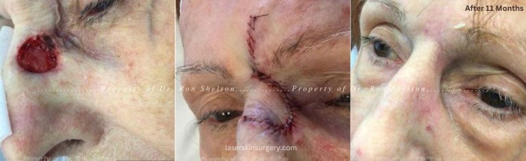 Mohs surgery on the nurse, Mohs repair and after 11 months