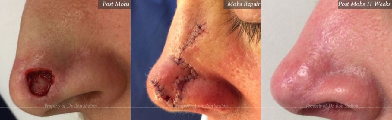 Mohs surgery on the nurse, post repair and after 11 weeks