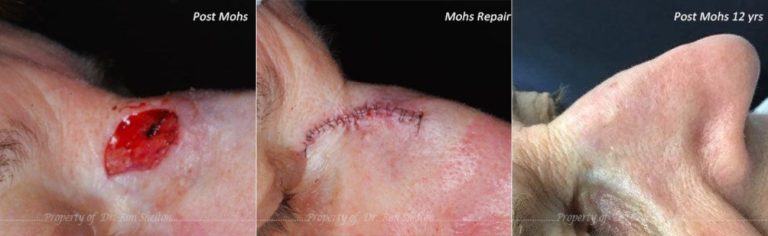 Post Mohs surgery, repair and Post Mohs 12 years on the nose