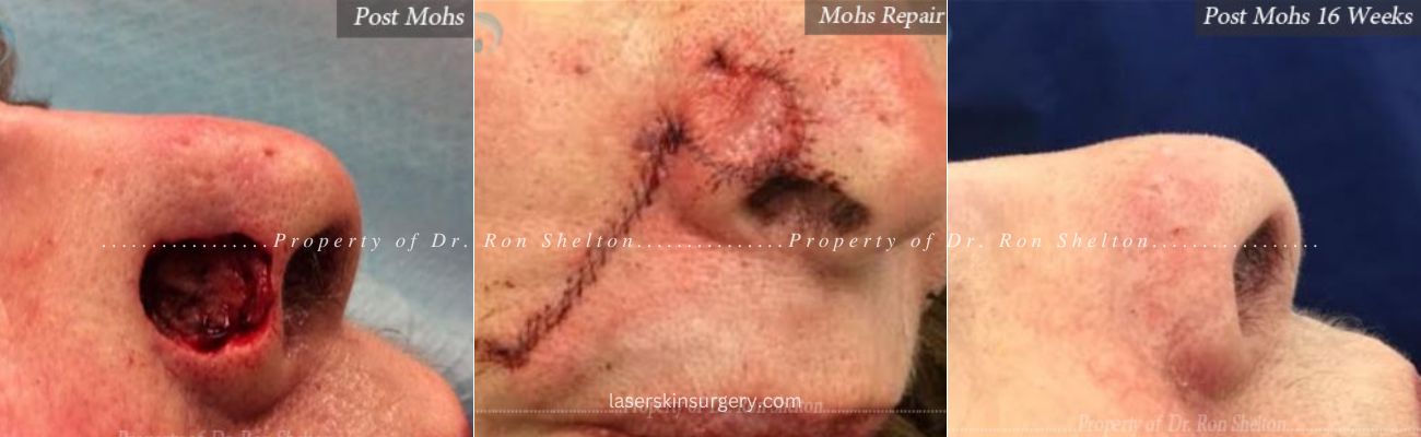 Mohs surgery on the nurse, post repair and after 16 weeks