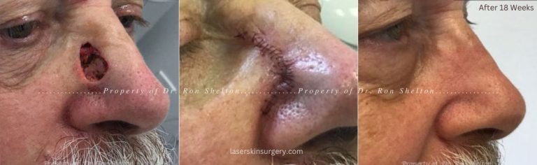 Mohs surgery, repair and after 18 weeks