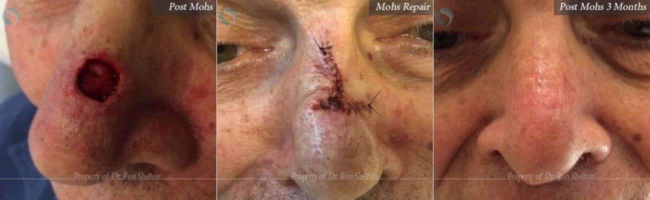 Mohs surgery on the nurse, post repair and after 3 months