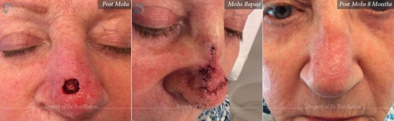 Mohs surgery on the nurse, post repair and after 8 months
