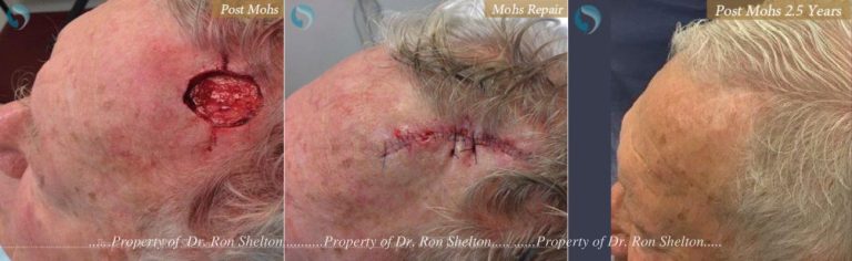 Mohs Surgery on the Scalp, Mohs Repair and After 2.5 Years
