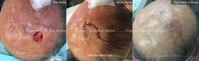 Mohs Surgery on the Scalp, Mohs Repair and After 4 Weeks