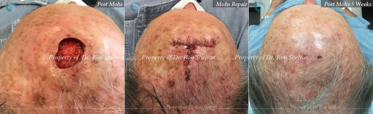 Mohs Surgery on the Scalp, Mohs Repair and After 6 Months