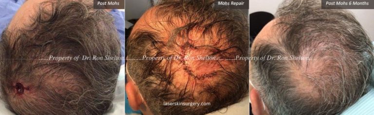 Mohs Surgery on the Scalp, Mohs Repair and After 6 Months