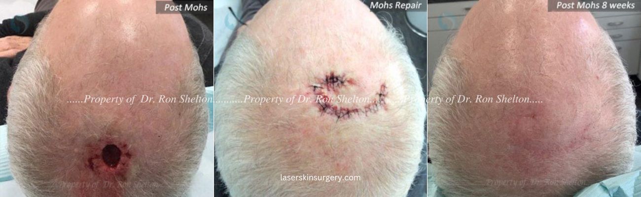 Mohs Surgery on the Scalp, Mohs Repair and After 8 Weeks