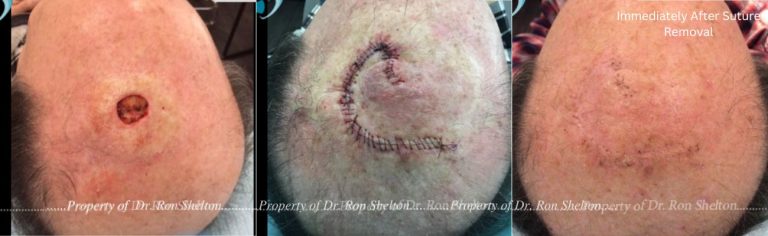 Mohs Surgery on the Scalp, Mohs Repair and Immediately After Suture Removal