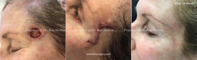 Mohs Surgery on the Temple, Repair and After 14 Weeks