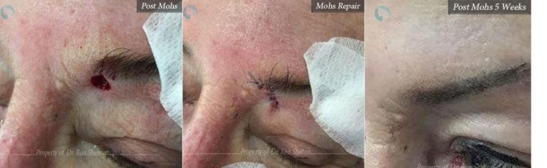 Mohs Surgery on the Eyelid, Repair and After 5 Weeks