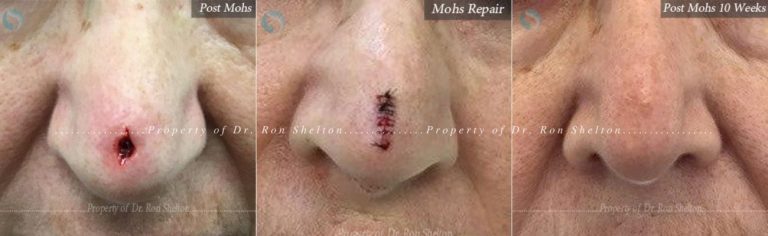 Post Mohs, Mohs Repair and Post Mohs 10 Weeks on the Nose
