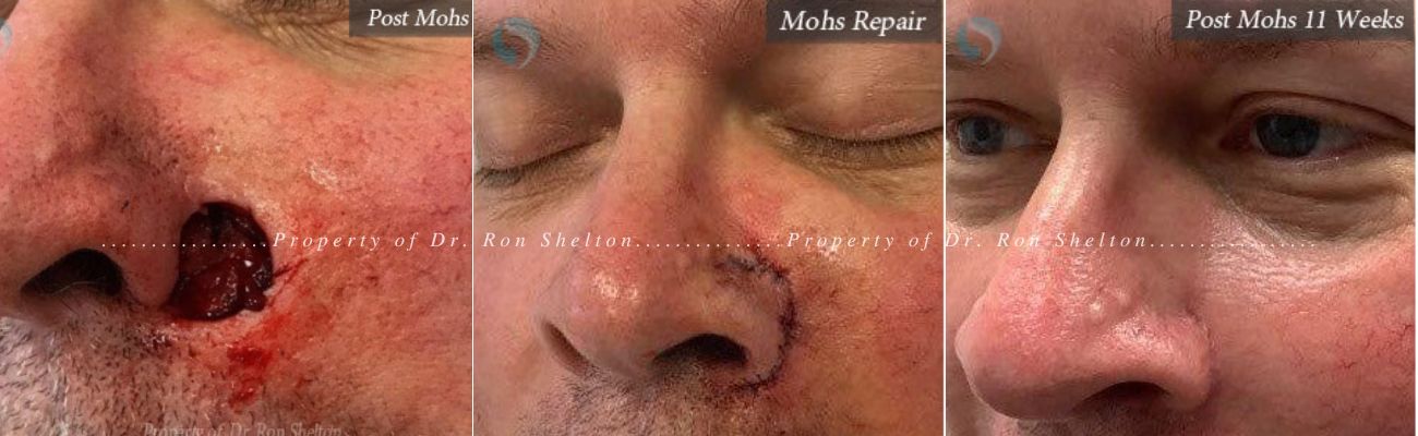 Mohs surgery on the nose, Repair and 11 weeks results