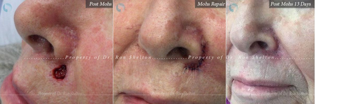 Post Mohs surgery on the nose, Mohs repair and after 13 Days