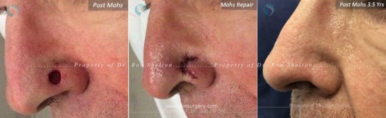 Mohs surgery on the nose, Mohs repair and After 3.5 Years
